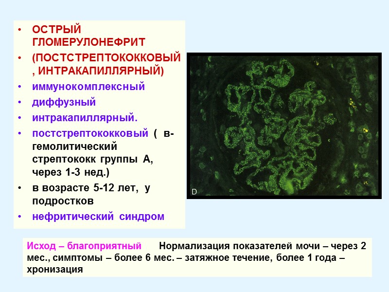 ОСТРЫЙ ГЛОМЕРУЛОНЕФРИТ  (ПОСТСТРЕПТОКОККОВЫЙ, ИНТРАКАПИЛЛЯРНЫЙ) иммунокомплексный диффузный интракапиллярный.  постстрептококковый (  в-гемолитический стрептококк